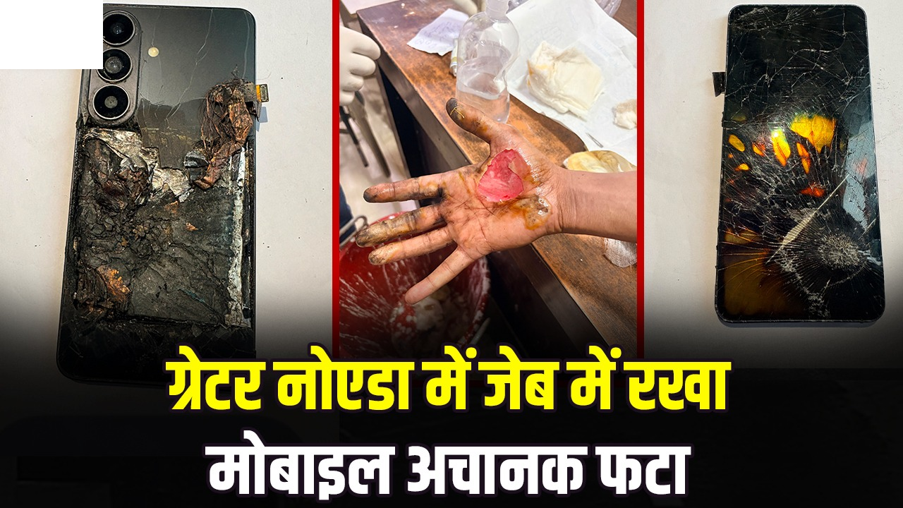 ग्रेटर नोएडा में जेब में रखा मोबाइल अचानक फटा, युवक के दोनों हाथ और प्राइवेट पार्ट झुलसे; एक महीने पुराना था फोन