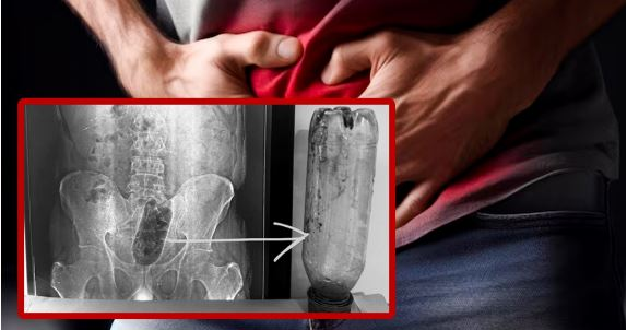 आगरा: निजी अंग में बोतल डालने से युवक की हालत बिगड़ी, सर्जरी से निकाली गई बोतल