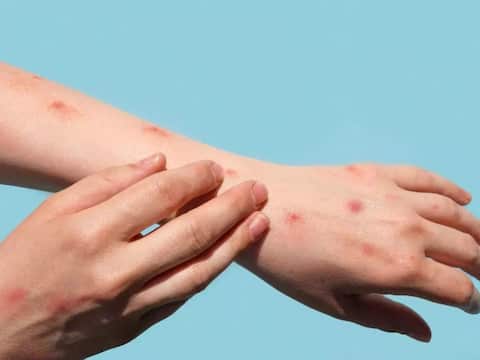 दुनियाभर में मंकीपॉक्स के 50 हजार केस अमेरिका-यूरोप बने हॉटस्पॉट WHO का अलर्ट