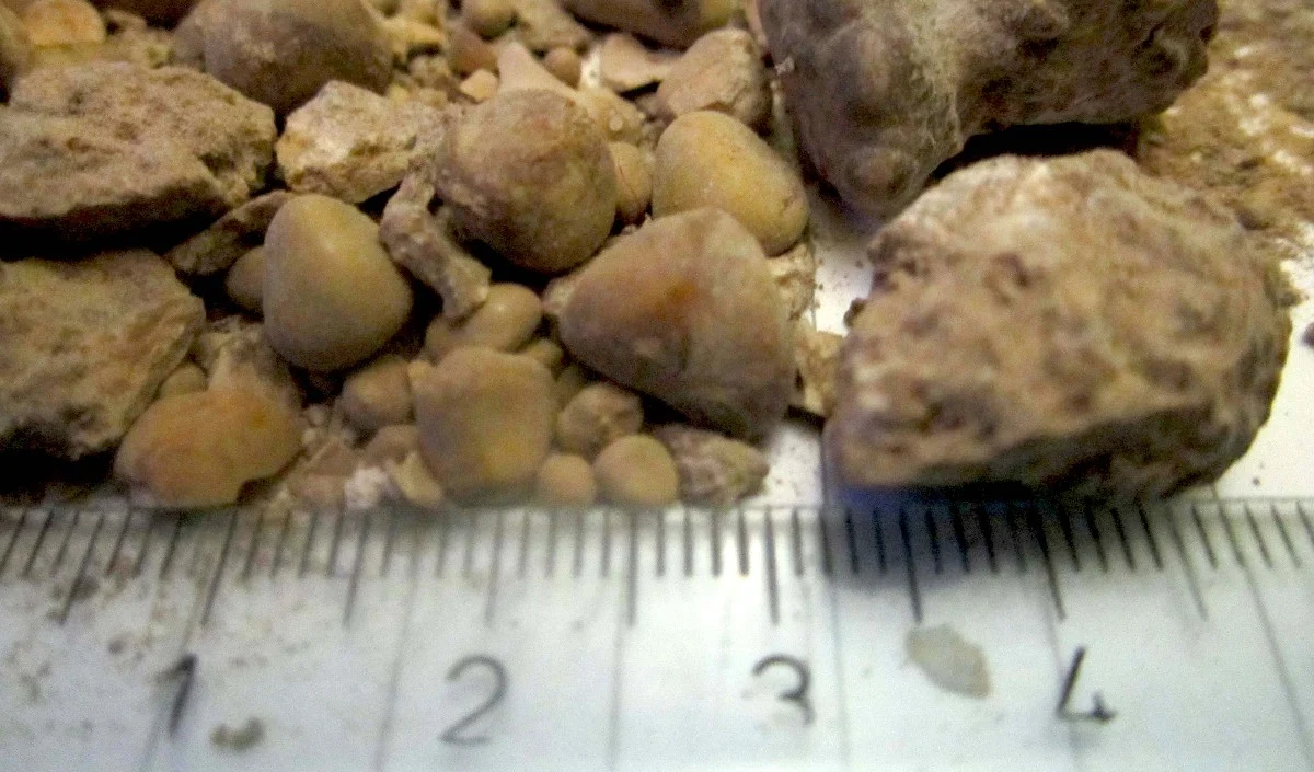 हैरान करने वाली सर्जरी डॉक्टर ने 1 घंटे में निकाली 206 गुर्दे की पथरी मरीज की दर्द से हालत थी खराब