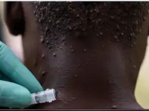 मंकीपॉक्स पर हेल्थ मिनिस्ट्री की एडवाइजरी